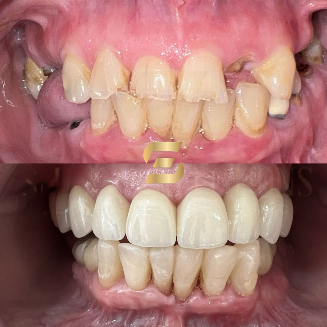 photo before and after getting full arch dental implants at Smile Perfections - top half showing before treatment with multiple missing teeth while bottom half showing a fully restored mouth with full arch on top and a few dental implants on the bottom jaw