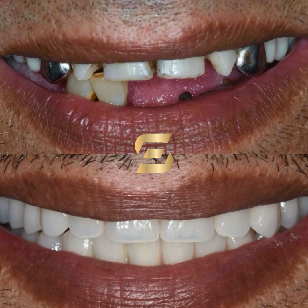 full mouth dental implants before and after photo - top half showing multiple missing teeth and also metal teeth while the bottom half showing fully restored mouth using same day teeth implants - photo taken at Smile Perfections