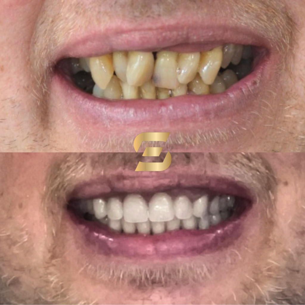 teeth in a day - before and after treatment photo - top half showing before treatment crooked and missing teeth while the bottom half showing fully restored mouth, using teeth in a day at Smile Perfections