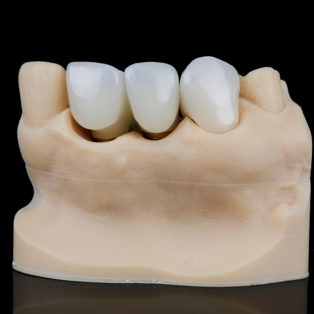 Dental crowns in Leicester at Smile Perfections dentist Leicester, showing an illustration explaining how crowns restore damaged teeth for improved function and appearance.