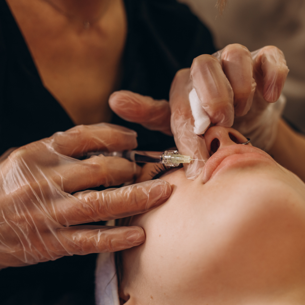 Dermal fillers in Leicester at Smile Perfections dentist Leicester, showing a close-up of lip enhancement treatment to restore volume and smoothness for a youthful appearance.