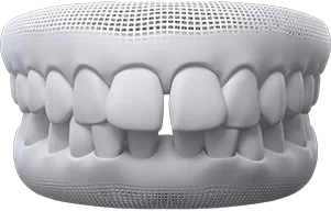 gaps between teeth illustration