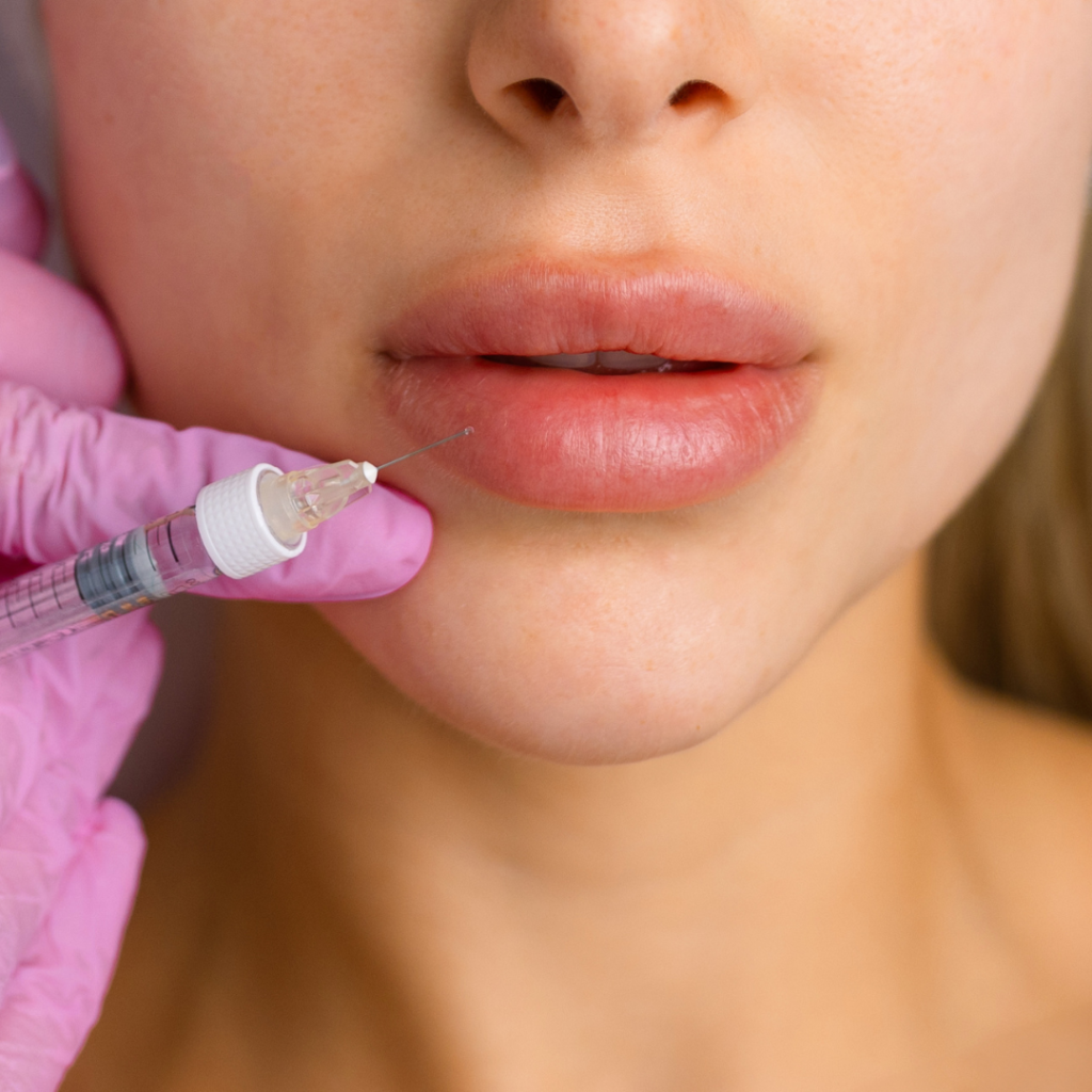 Lip fillers in Leicester at Smile Perfections dentist Leicester, showing a close-up of a girl’s lips during cosmetic treatment to enhance volume and shape.