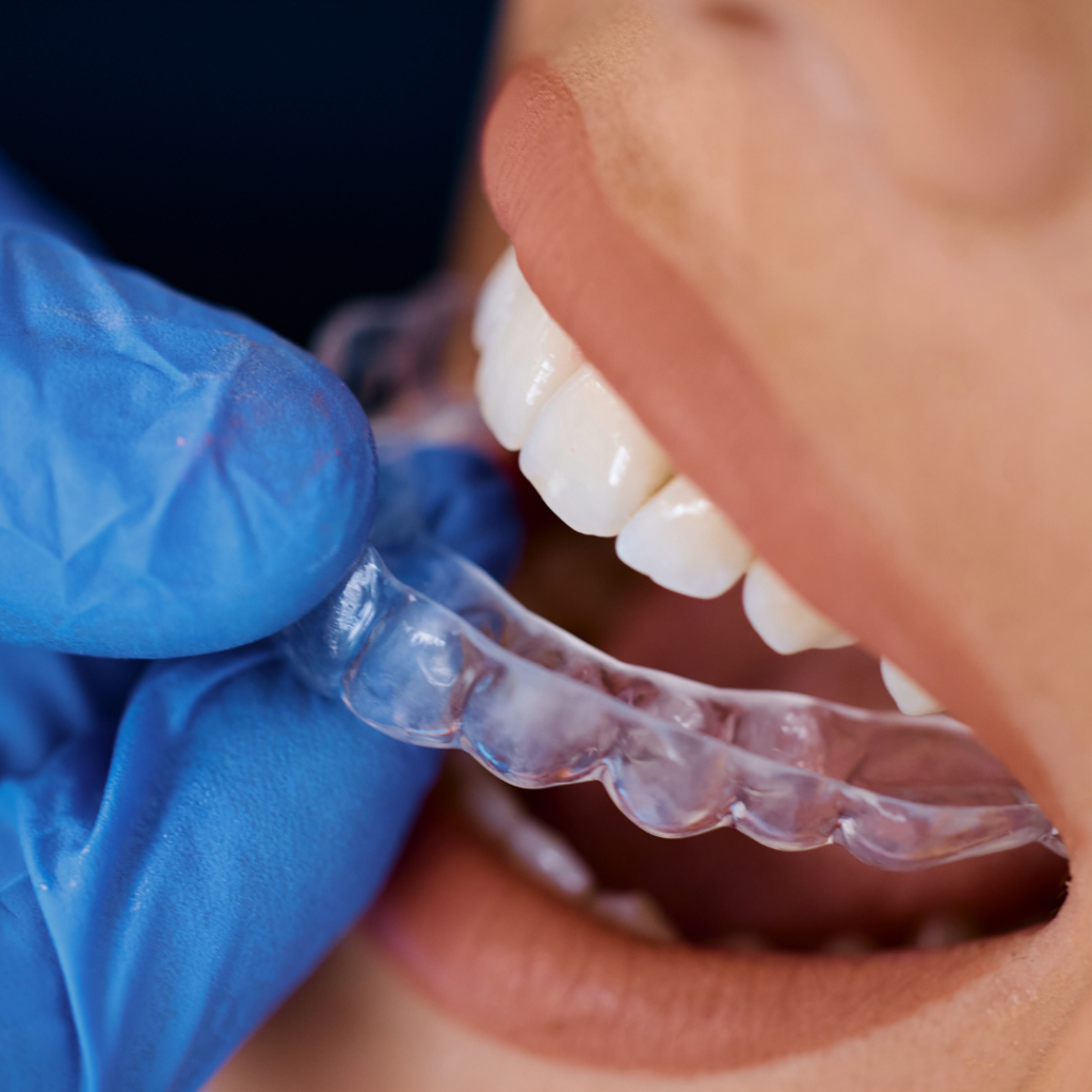 Six Month Smiles in Leicester at Smile Perfections dentist Leicester, showing invisible braces fitted on teeth for discreet and efficient orthodontic treatment.