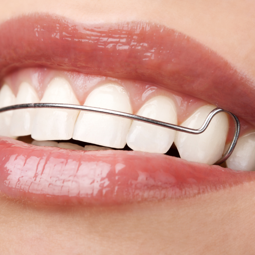 The process of Inman Aligner in Leicester at Smile Perfections dentist Leicester, showing a metal frame across the upper arch used for quick and effective front teeth alignment.