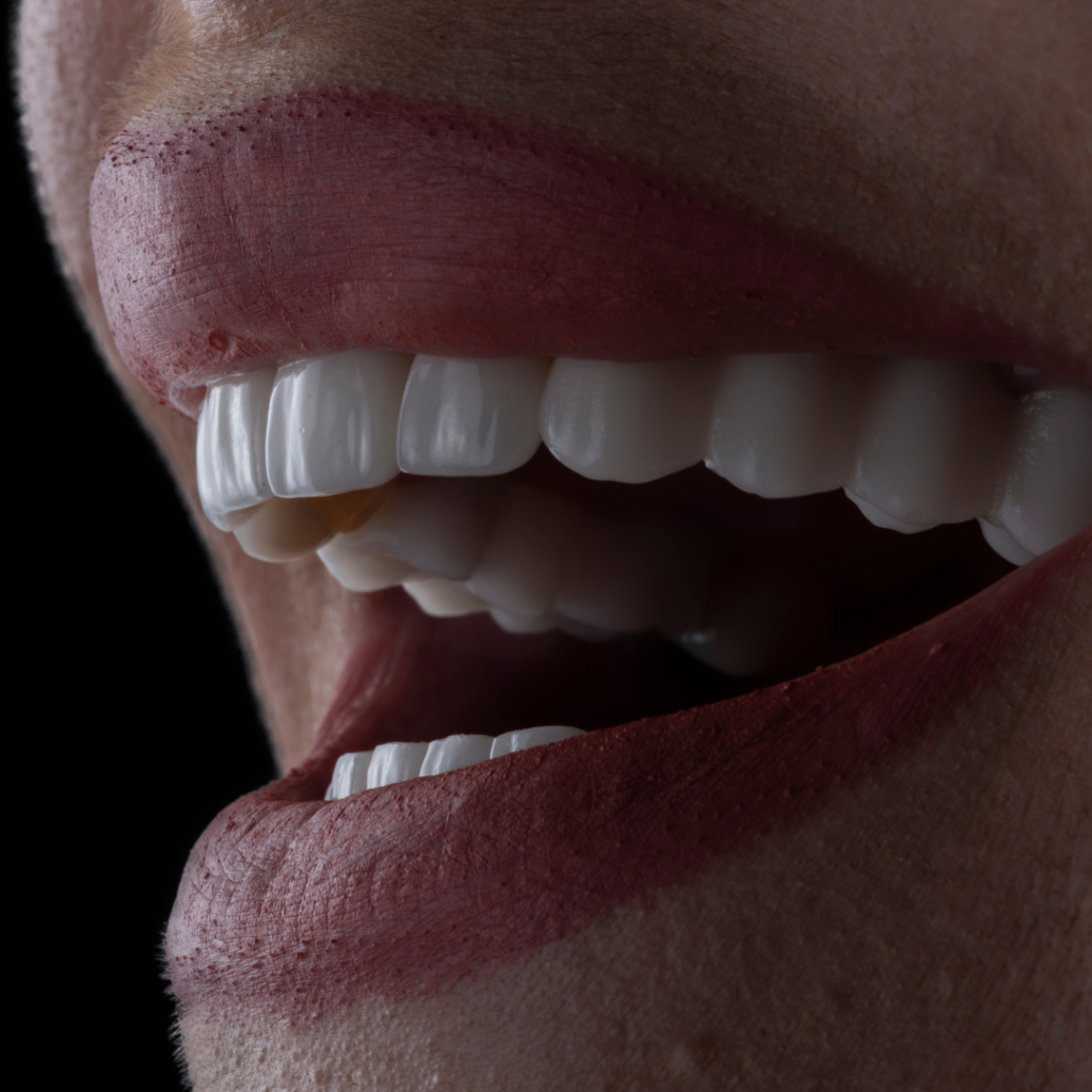 Veneers in Leicester at Smile Perfections dentist Leicester, close-up photo showing natural-looking porcelain veneers enhancing tooth shape and smile aesthetics.