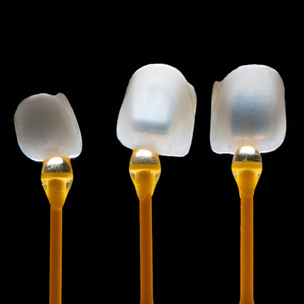 Three veneers example in Leicester at Smile Perfections dentist Leicester, showcasing porcelain veneers used to improve the appearance of front teeth.