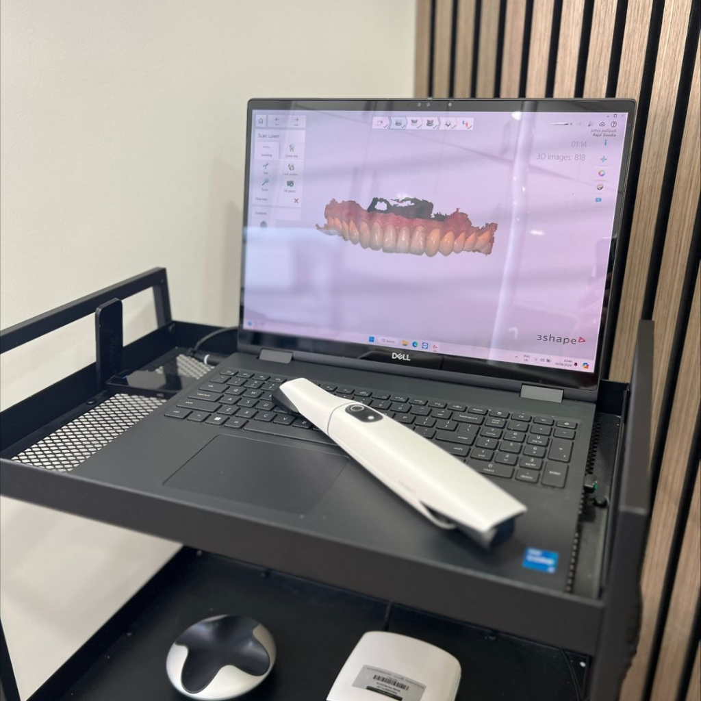 3D oral scanner at Smile Perfections in Leicester, used for precise digital impressions and advanced treatment planning in modern dentistry.