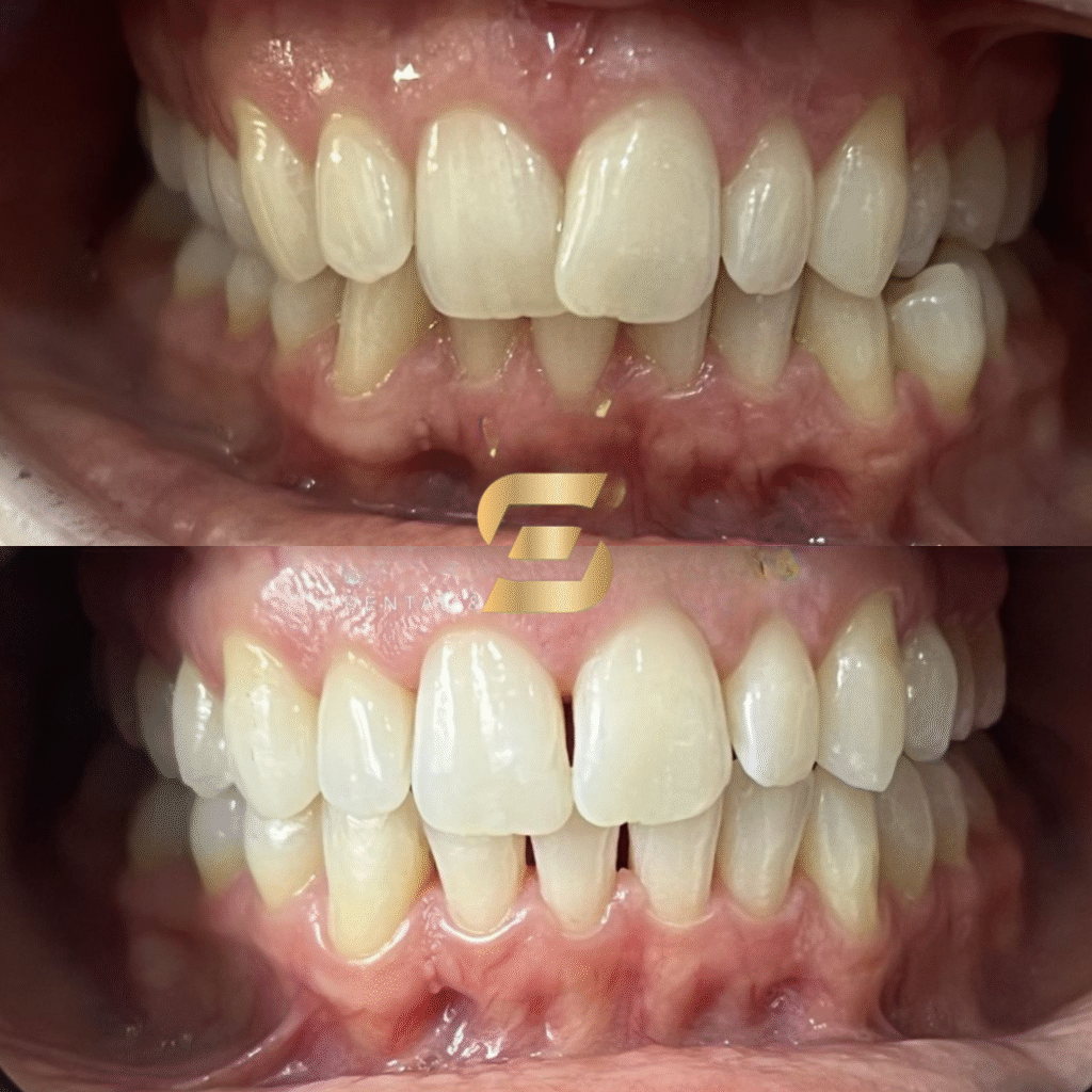 before and after Invisalign treatment - top half shows before treatment while bottom half shows after treatment having a straighter smile - photo taken at Smile Perfections in Leicester