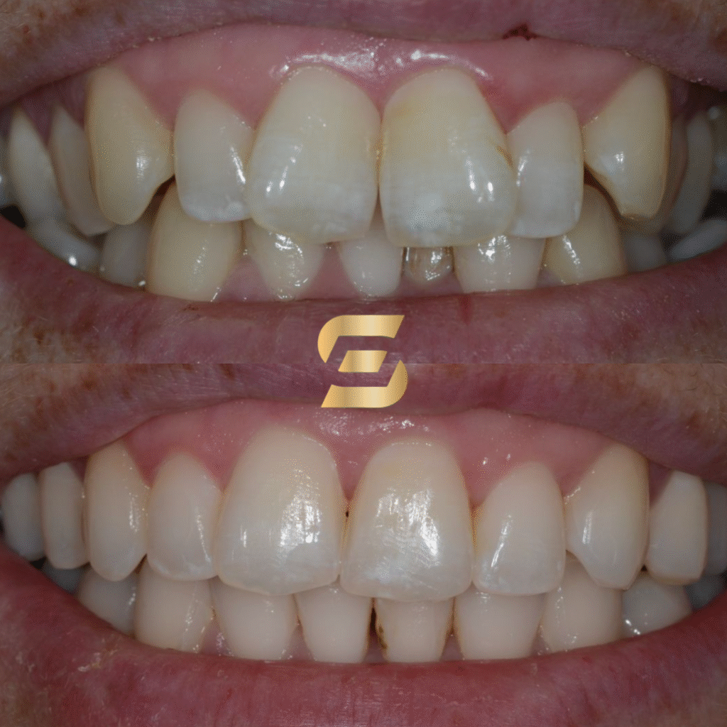 before and after Invisalign treatment - top half shows before treatment while bottom half shows after treatment having a straighter smile - photo at Smile Perfections in Leicester