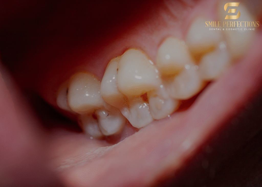 how long do dental fillings last - photo with a dental filling