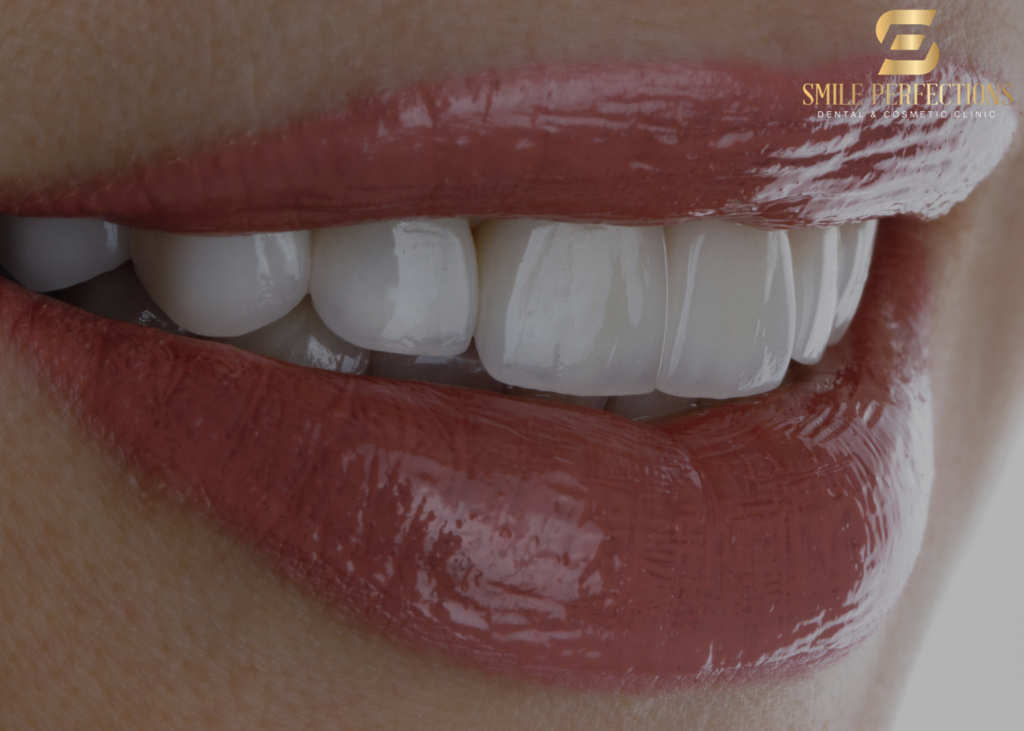 what are veneers - close-up photo with veneers