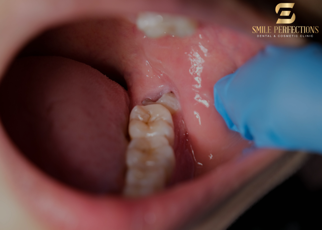 wisdom tooth soreness - photo with a partially erupted wisdom tooth