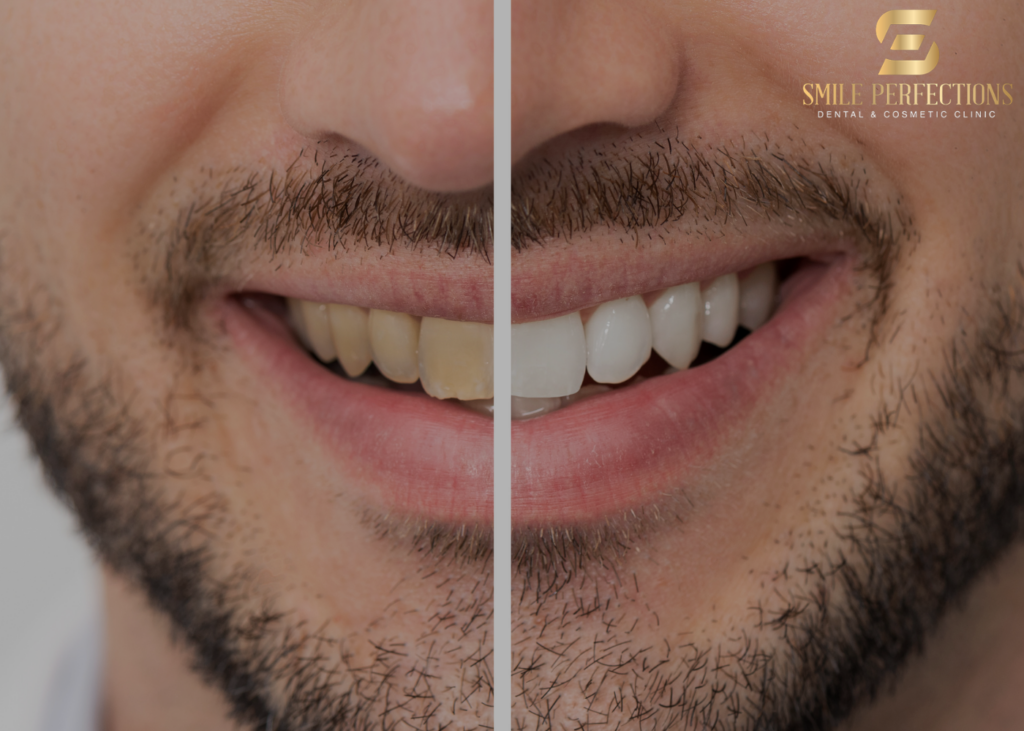 how long does teeth whitening last - blog