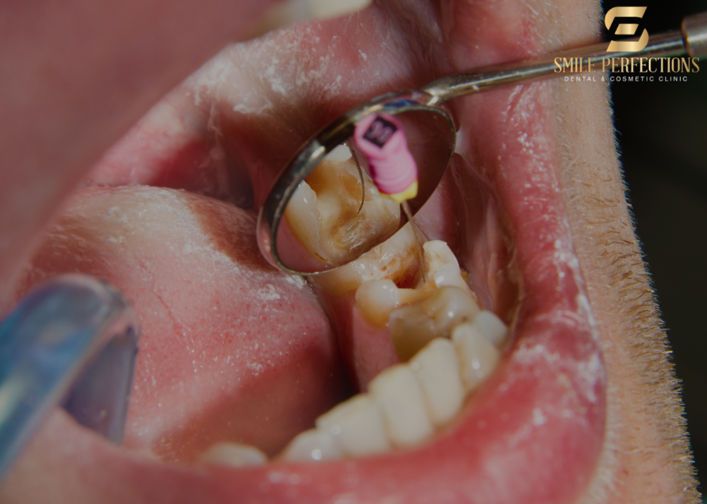 endodontics - photo of root canal treatment procedure