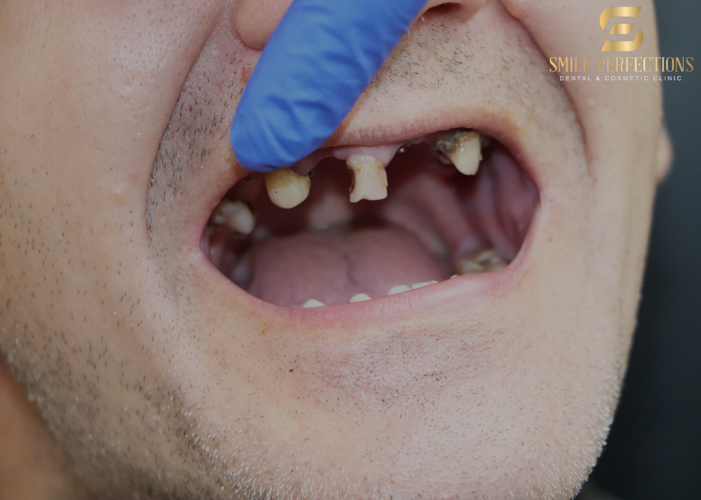 rotten teeth - how it looks
