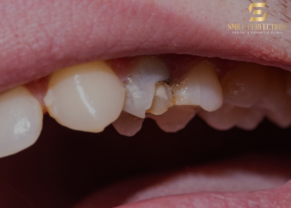black tooth cracked